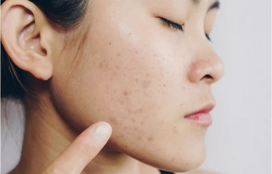 Dark Spots From Acne